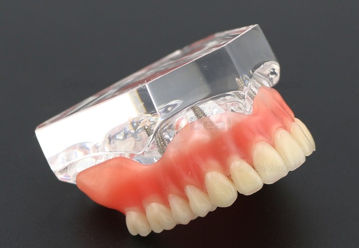 Dental Teeth Implant Overdenture Model Upper Jaw With 4 Implants Study Demo Model 6001